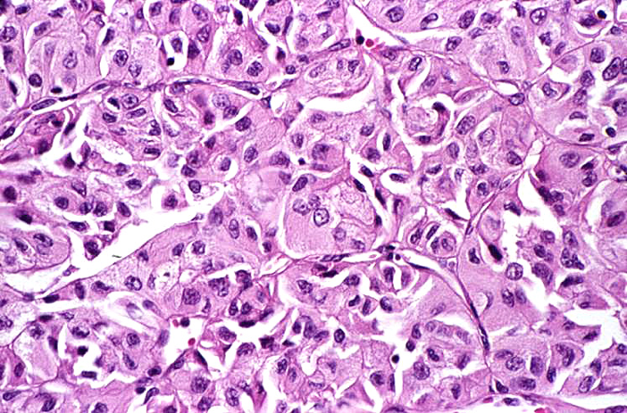 Hurthle Cell Cancer Diagnosis
