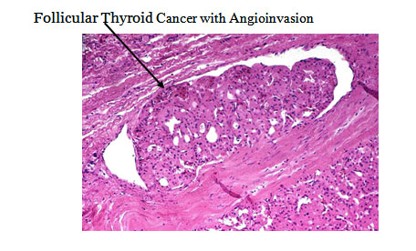 Follicular Thyroid Cancer with Angioinvasion