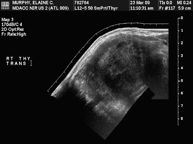 Ultrasound of the thyroid gland showing a thyroid nodule