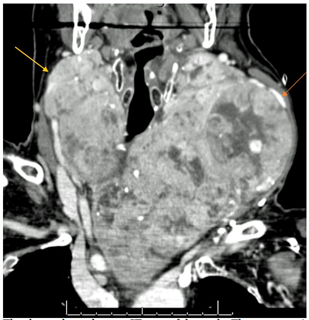 Thyroid cancer scan