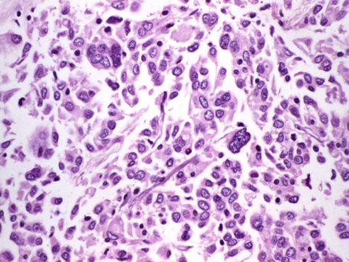 Anaplastic Thyroid Cancer Diagnosis