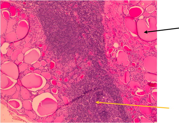 Hashimotos Pathology Slide