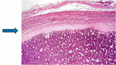 Thyroid cancer histology