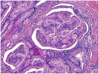 Thyroid cancer histology