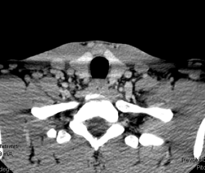 Suspicious right lateral neck lymph node