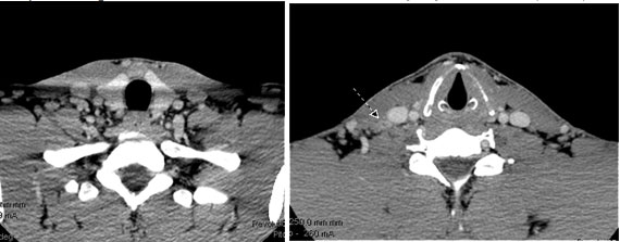 Thyroid cancer scan