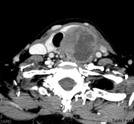 CT Scan of anaplastic thyroid cancer