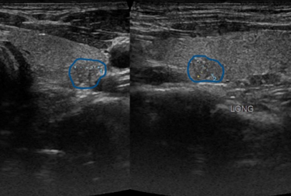 Interesting case of the week: Enlarged Lymph Nodes in the Neck in a Young Adult with Dr. Nate Walsh 2