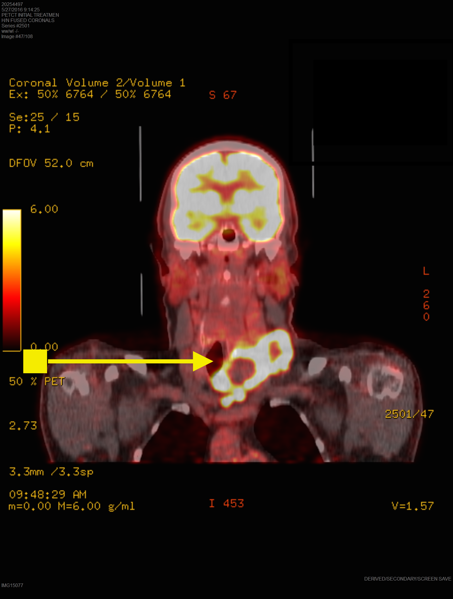 PET scan anaplastic thyroid cancer