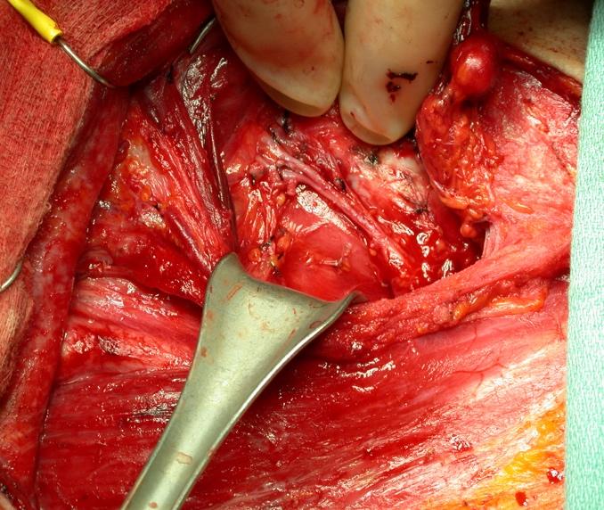 Recurrent laryngeal nerves