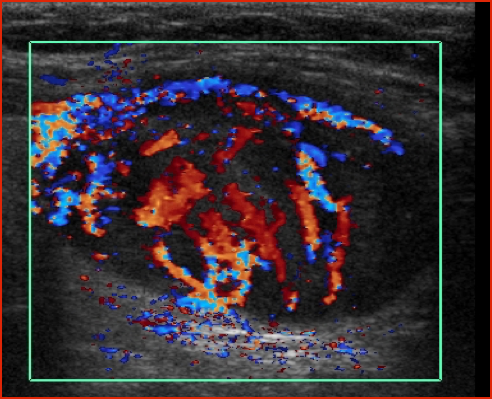 Ultrasound of the thyroid gland showing a thyroid nodule