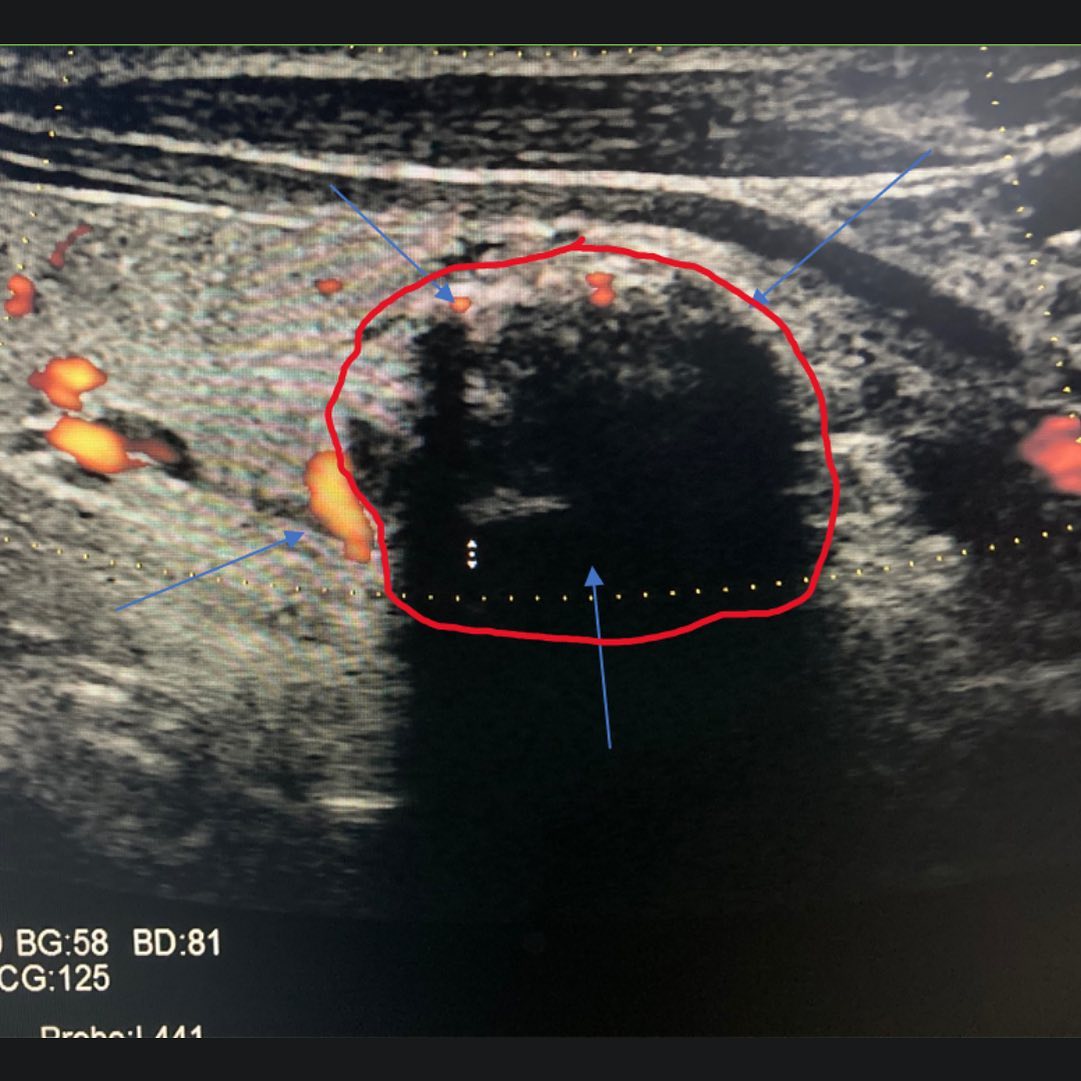 Interesting case of the week: Underdiagnosed Aggressive Papillary Thyroid Cancer in Multiple Locations With Dr. Nate Walsh 2