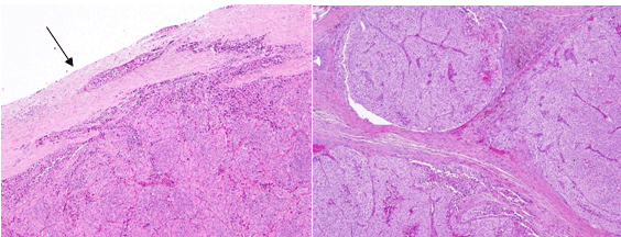 Hurthle Cell Cancer Invading the Thyroid Capsule