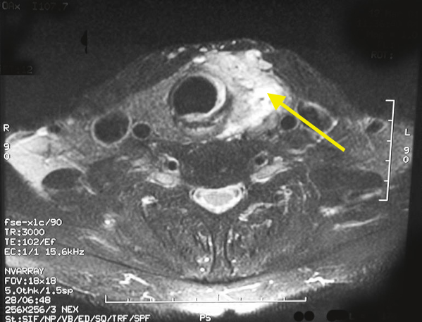 MRI of a papillary thyroid cancer of the left thyroid lobe