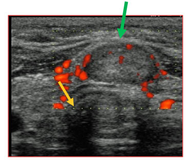 Thyroid cancer scan