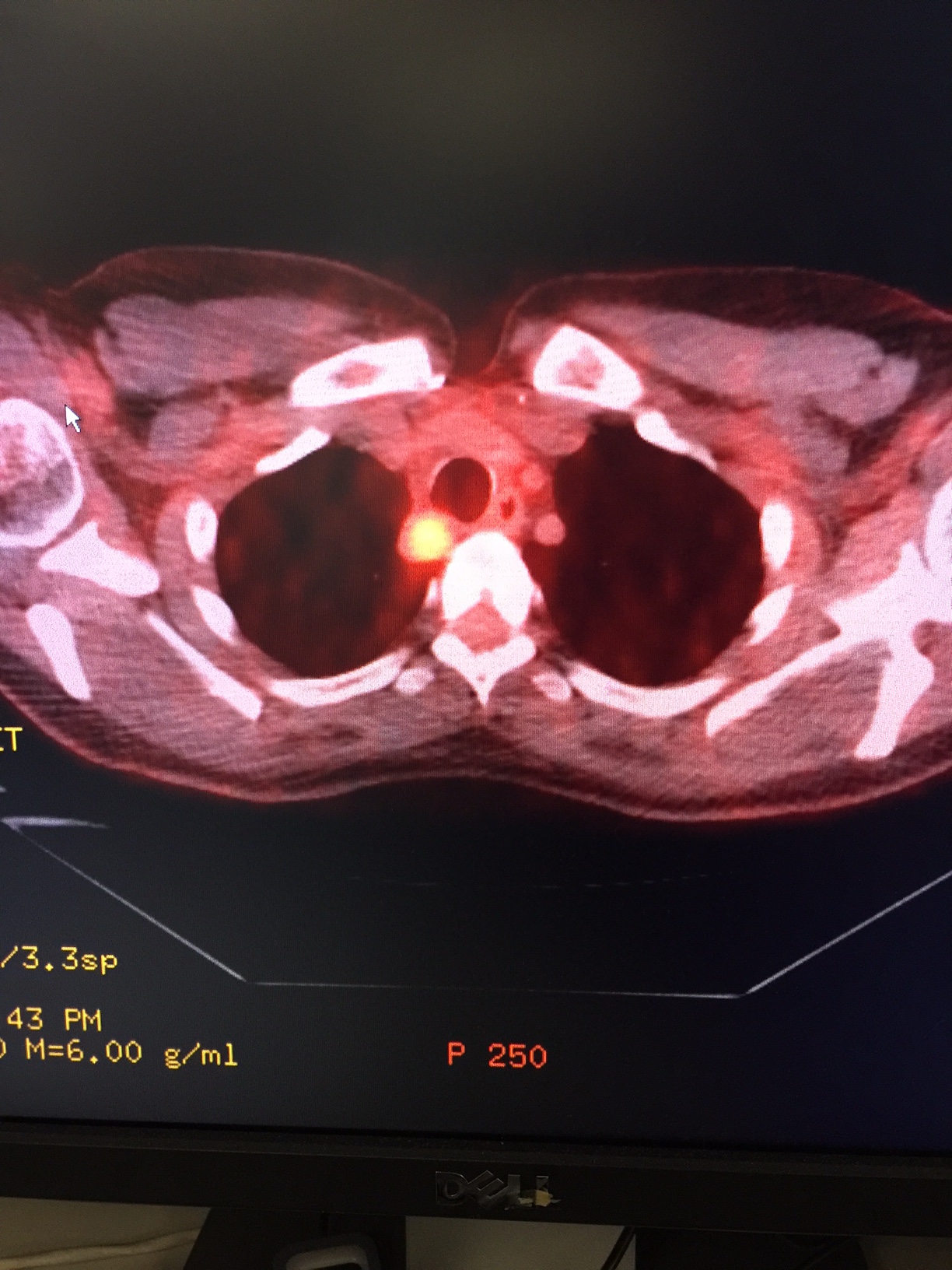 PET/CT scan of a patient with recurrent papillary thyroid cancer