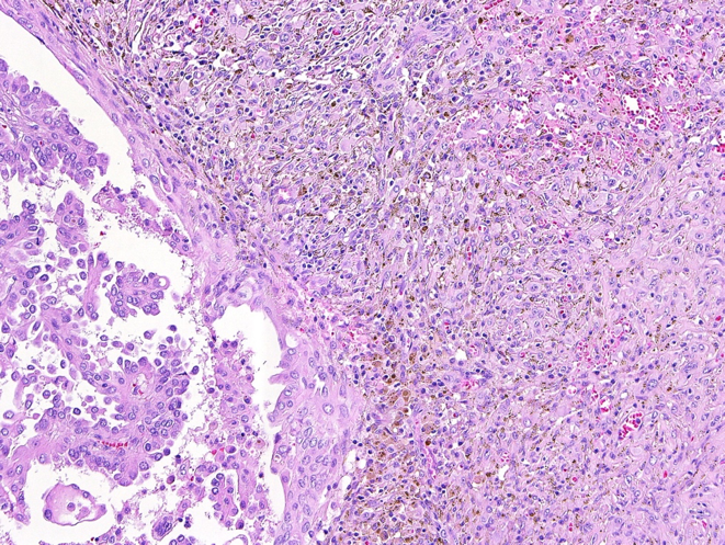 Microscope examination of anaplastic thyroid cancer starting from papillary