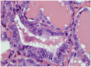 Thyroid cancer histology slide