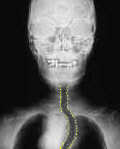 Thyroid Goiter causing deviation of the trachea