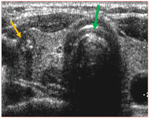 ultrasound of thyroid