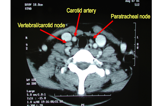 A CT scan of a patient with a diagnosis of papillary thyroid cancer. 