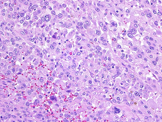 Anaplastic thyroid cancer giant cells