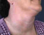 Thyroid Goiter