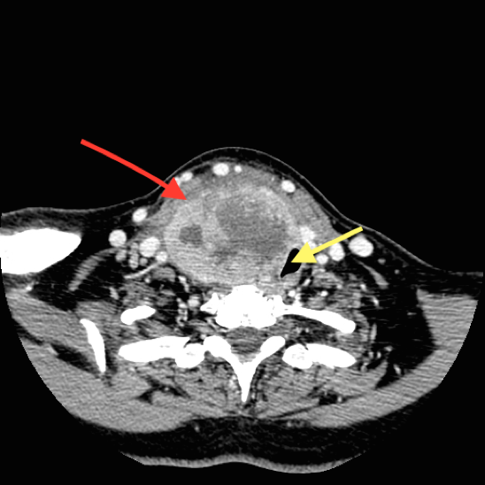 CT scan of anaplastic thyroid cancer