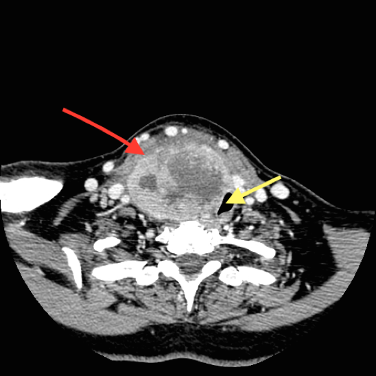 Anaplastic Thyroid Cancer Diagnosis