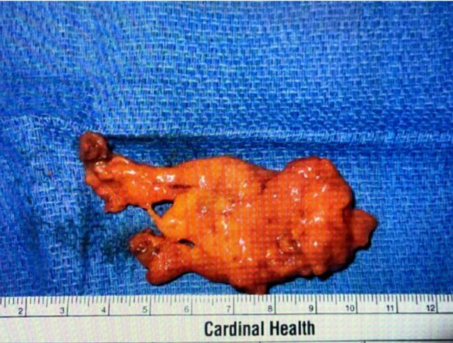Interesting case of the week: Metastatic Papillary Thyroid Cancer and Hyperparathyroidism with Dr. Rashmi Roy 2