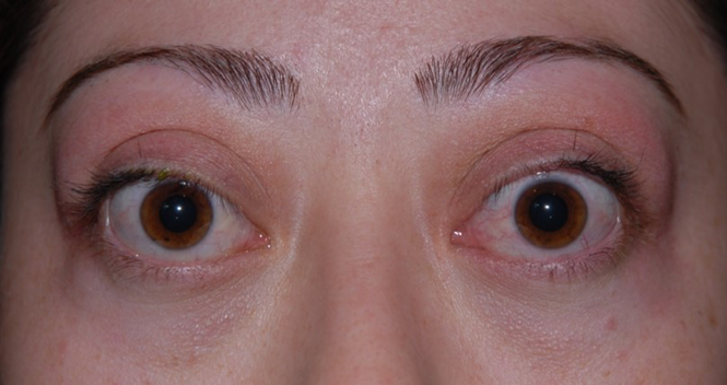 Imagen de una mujer con oftalmopatía grave.