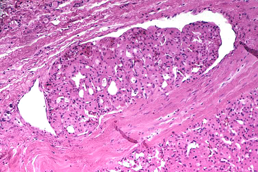Hurthle Cell Cancer with Angioinvasion