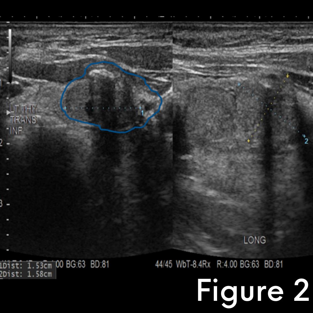 Interesting case of the week: Metastatic Thyroid Cancer with Benign Thyroid Biopsy: A Cautionary Tale, with Dr. Nate Walsh 2