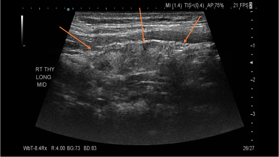 Thyroiditis Ultrasound