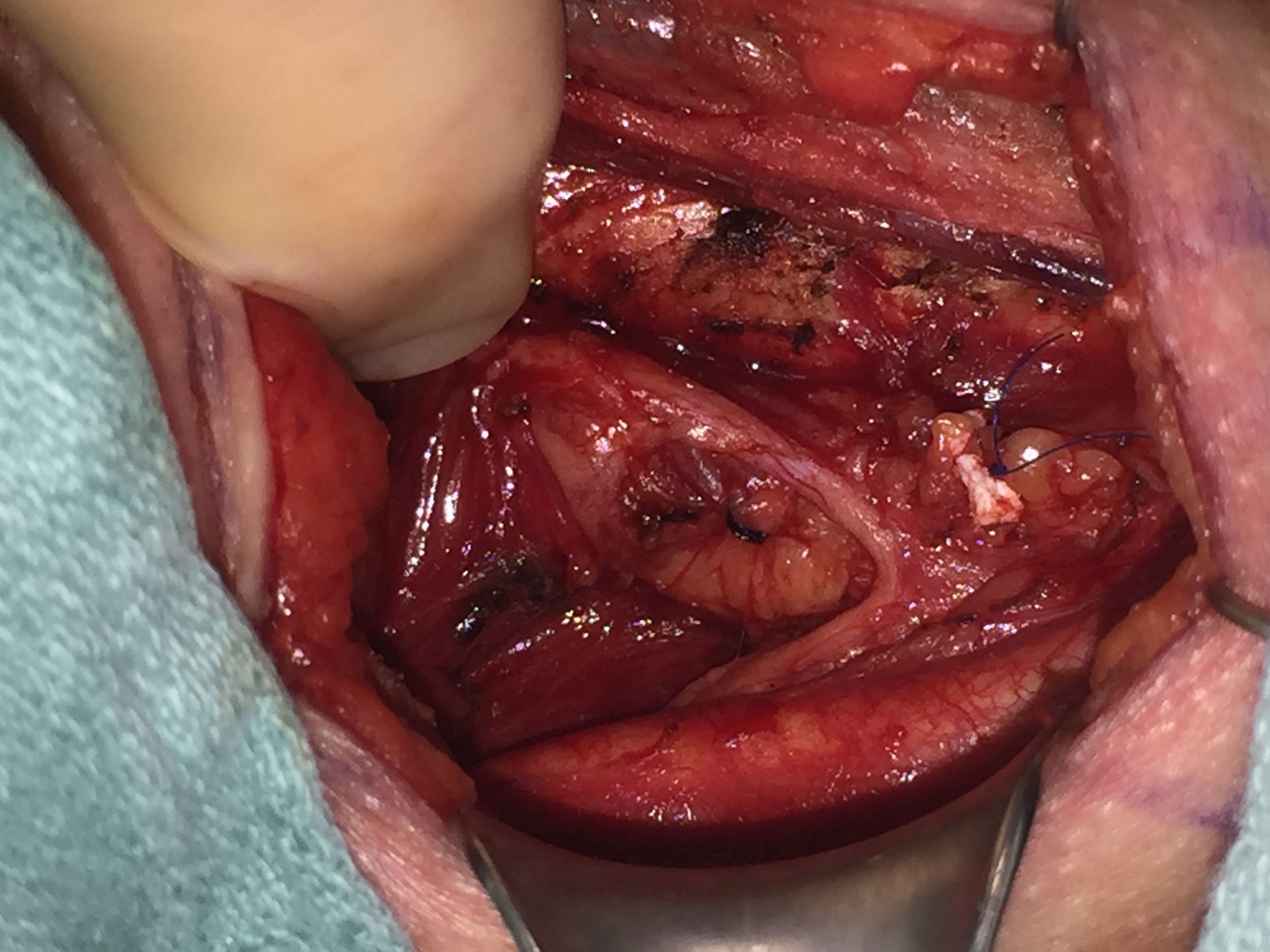 Non-recurrent laryngeal nerve