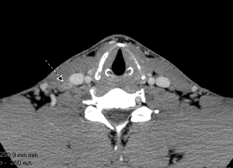CT scan neck revealing suspicious right neck mass confirmed to be medullary thyroid cancer