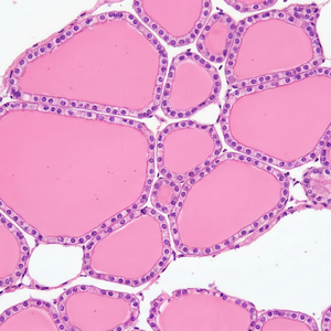 Small+thyroid+cancer