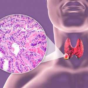 Papillary+thyroid+cancer+with+lymph+node+involvement