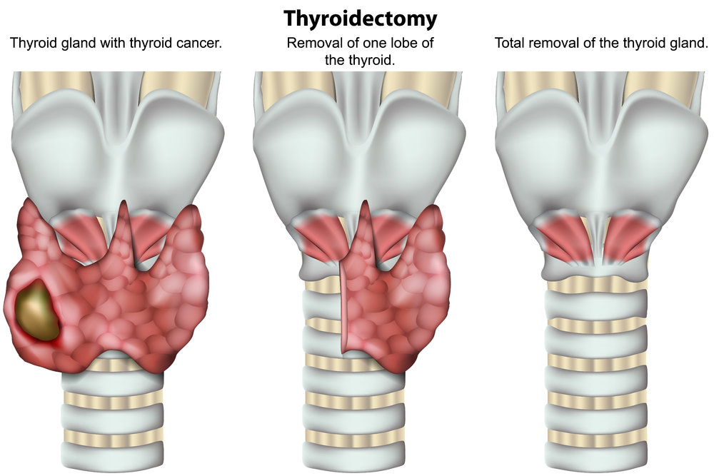 The Best Thyroid Operations For Thyroid Cancer